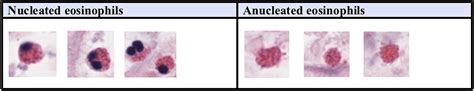 eosinophilia death.